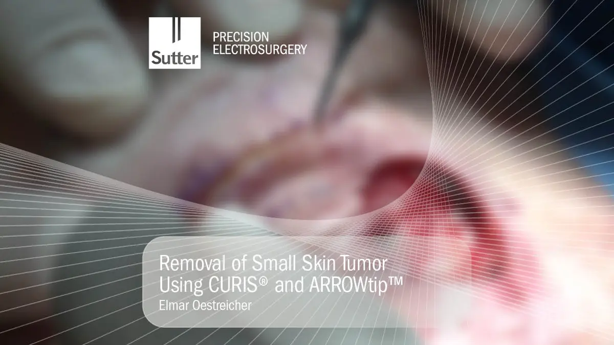 Blurred Removal of small skin tumor using CURIS® radiofrequency generator and ARROWtip™, surgical procedure by Dr. Elmar Oestreicher