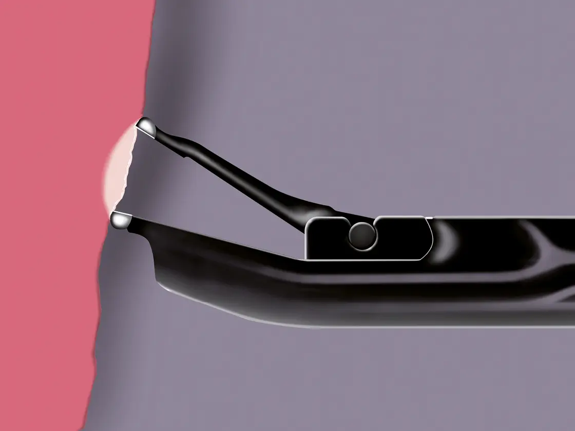 Grafische Darstellung einer Calvian bipolaren Zange, die Gewebe zwischen den Spitzen hält.