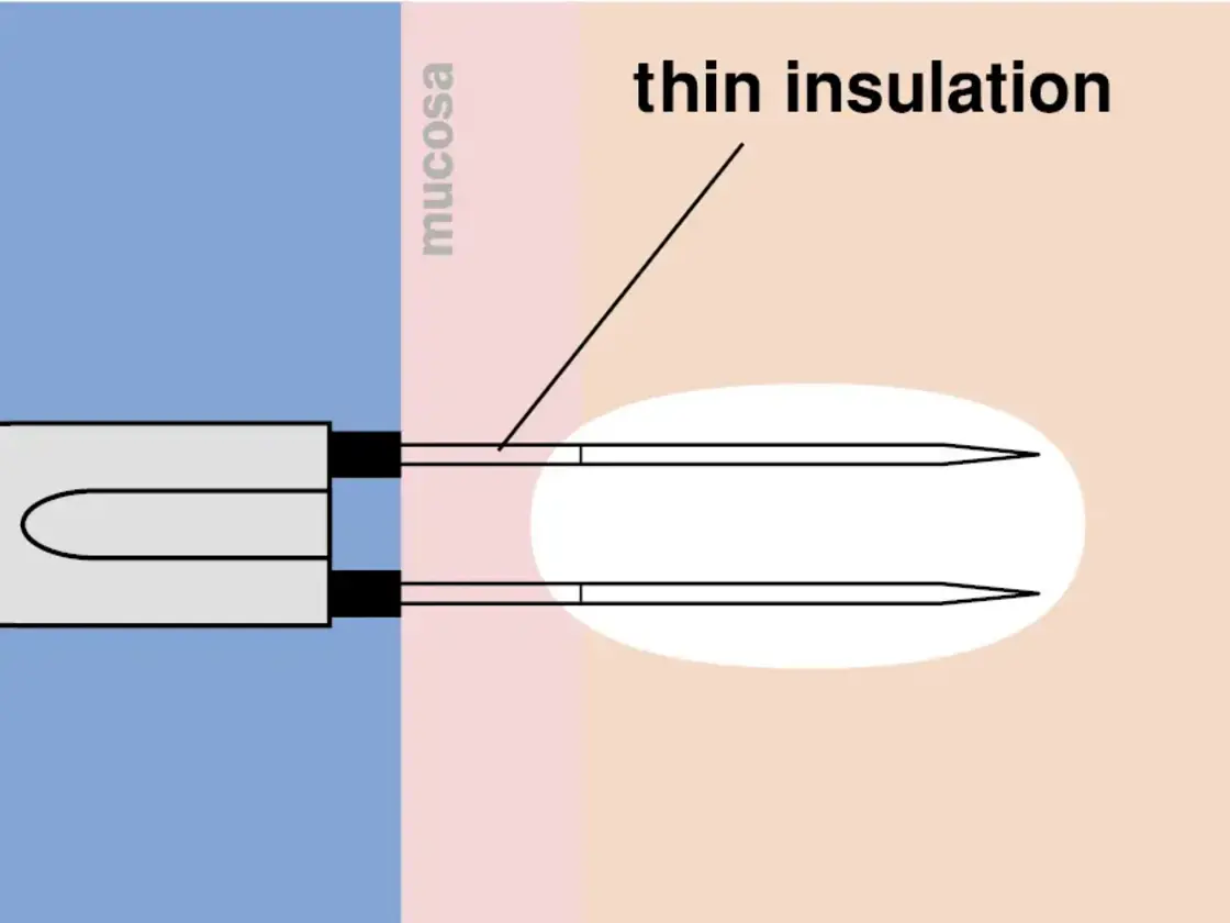 Grafische Darstellung der korrekt platzierten RaVoR™ bipolaren Elektrode an Nasenmuschel und Weichgaumen. Das vollständige Einführen der dünnen Isolation schützt die Schleimhaut vor Oberflächenläsionen.