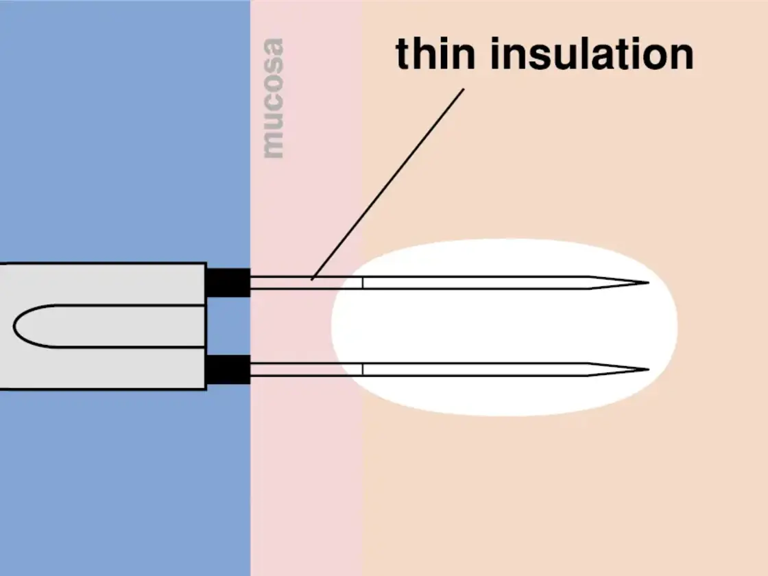 Grafische Darstellung der korrekt platzierten RaVoR™ bipolaren Elektrode an Nasenmuschel und Weichgaumen. Das vollständige Einführen der dünnen Isolation schützt die Schleimhaut vor Oberflächenläsionen.