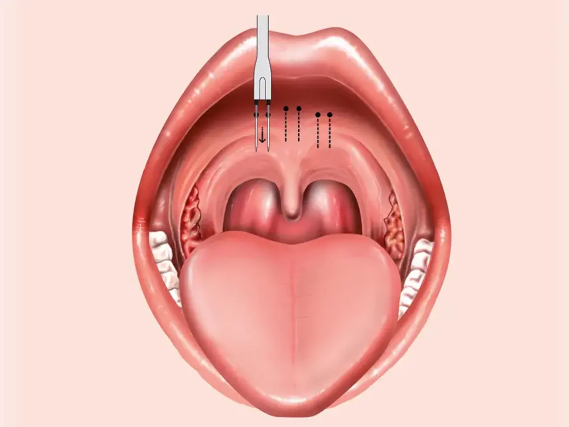 Grafische Darstellung der Einstichstellen für die Applikation der Radiofrequenzenergie am Zungengrund