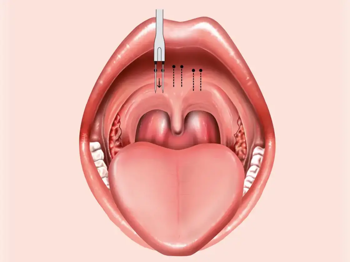Grafische Darstellung der Einstichstellen für die Applikation der Radiofrequenzenergie am Zungengrund