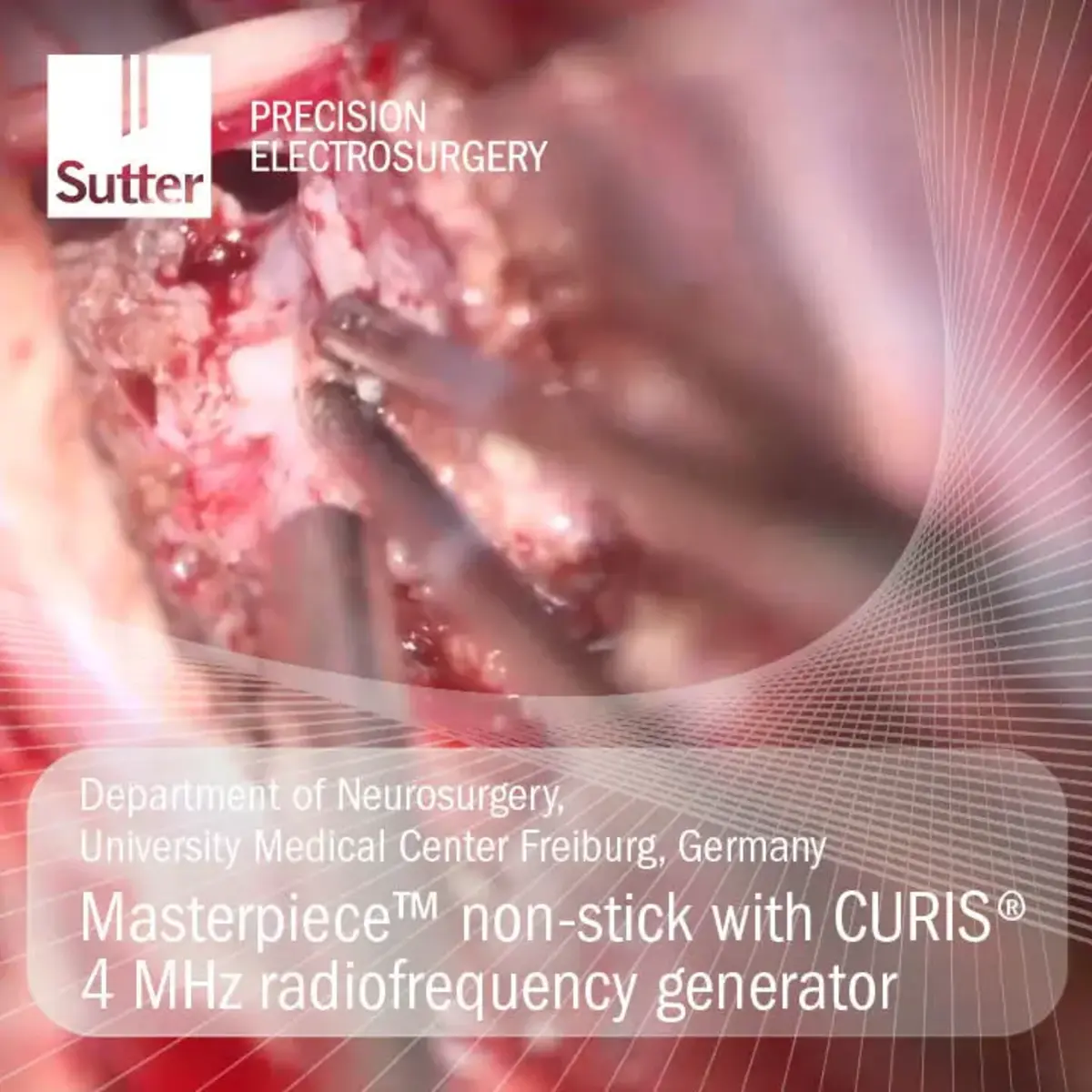 Neurosurgical procedure using Masterpiece™ non-stick bipolar forceps with CURIS® 4 MHz radiofrequency generator at University Medical Center Freiburg, Germany