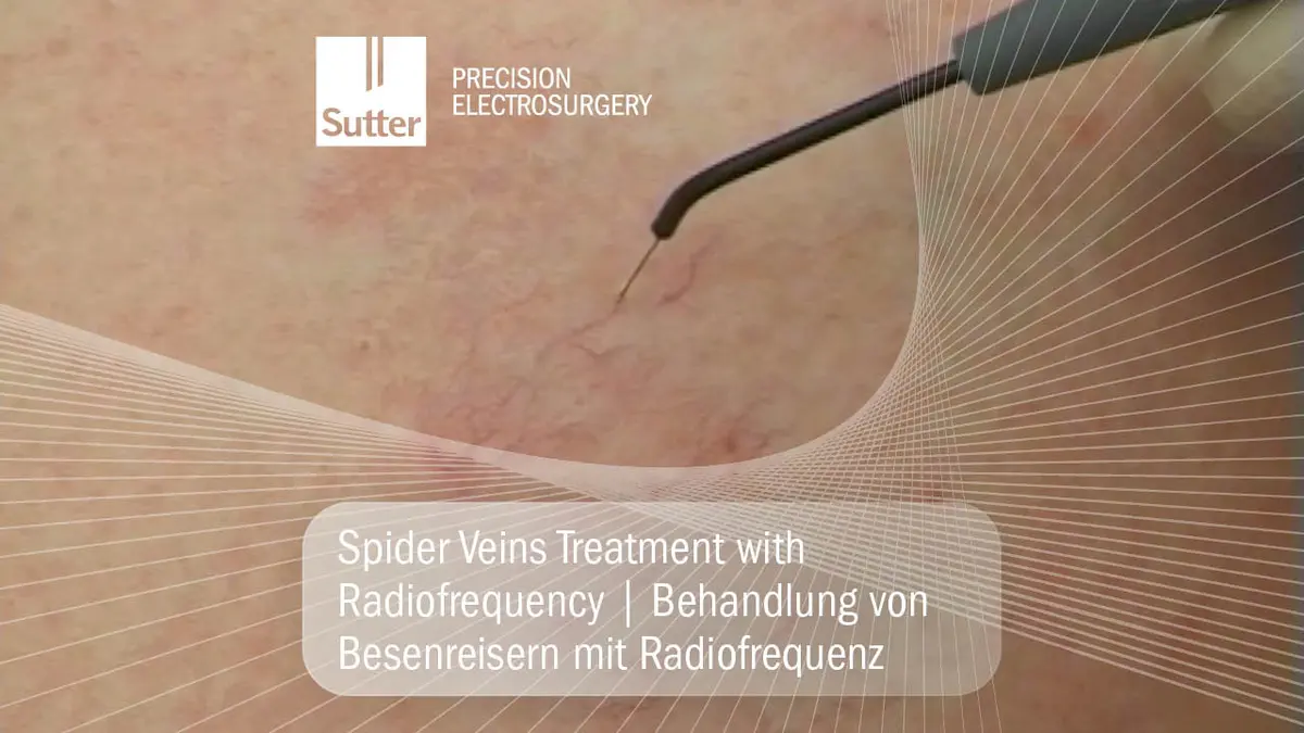 Radiofrequenzgestützte Behandlung von Besenreisern auf der Hautoberfläche mit einer feinen Elektrode.