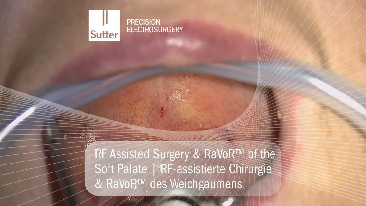 Nahaufnahme einer RaVoR™ Radiofrequenz-Volumenreduktion am Weichgaumen