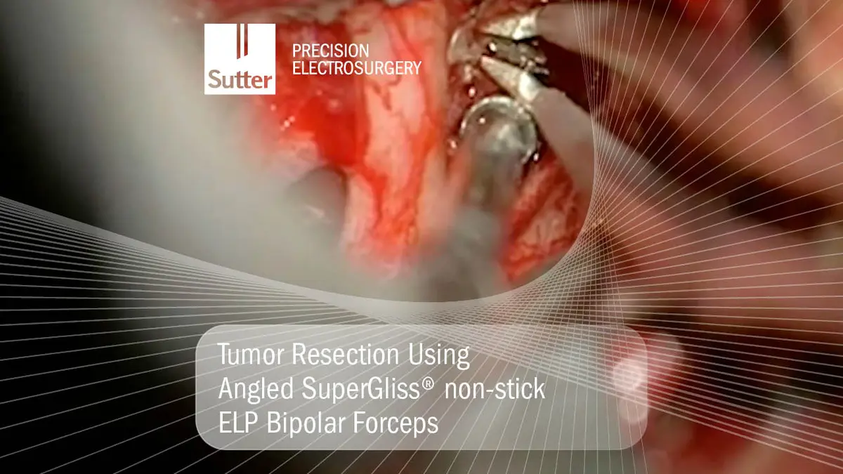 Surgical scene showing tumor resection using angled SuperGliss® non-stick ELP bipolar forceps for precise electrosurgical procedures.