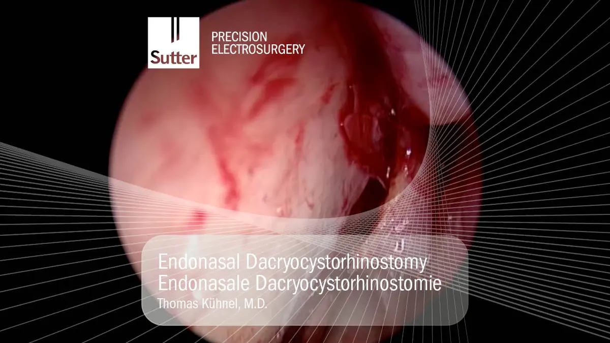 Endoskopische Ansicht einer Nasenmuschel während der Radiofrequenzbehandlung einer chronischen Rhinitis mit der RaVoR™-Technologie; minimalinvasives Verfahren zur Reduktion von Schleimhautvolumen.