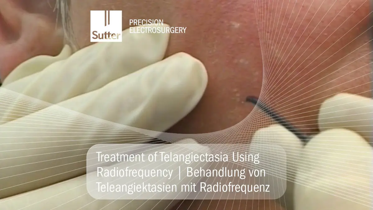 Behandlung von Teleangiektasien mit Radiofrequenz auf der Haut