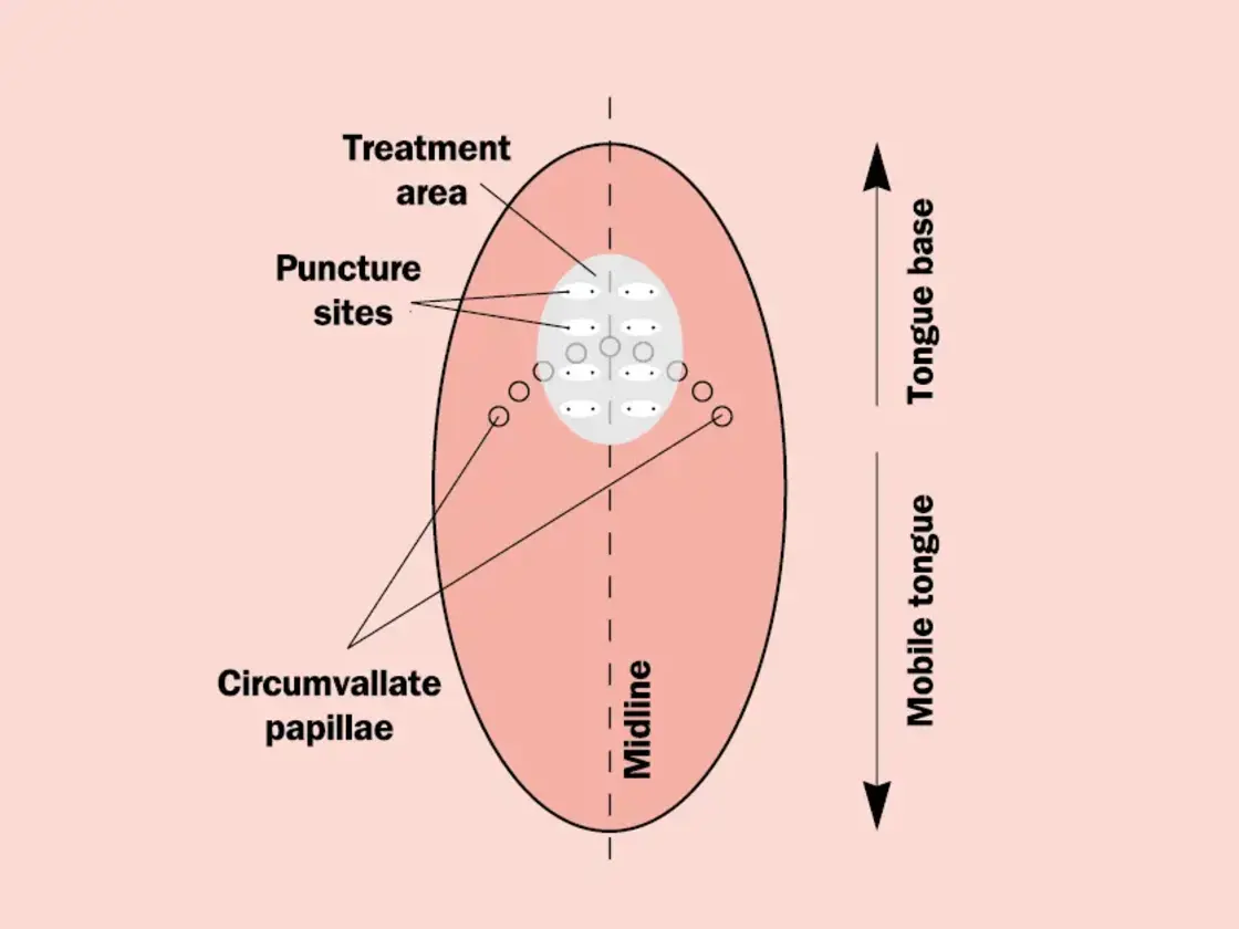 Grafische Darstellung der Einstichstellen für die Applikation der Radiofrequenzenergie am Zungengrund. mit Beschriftungen