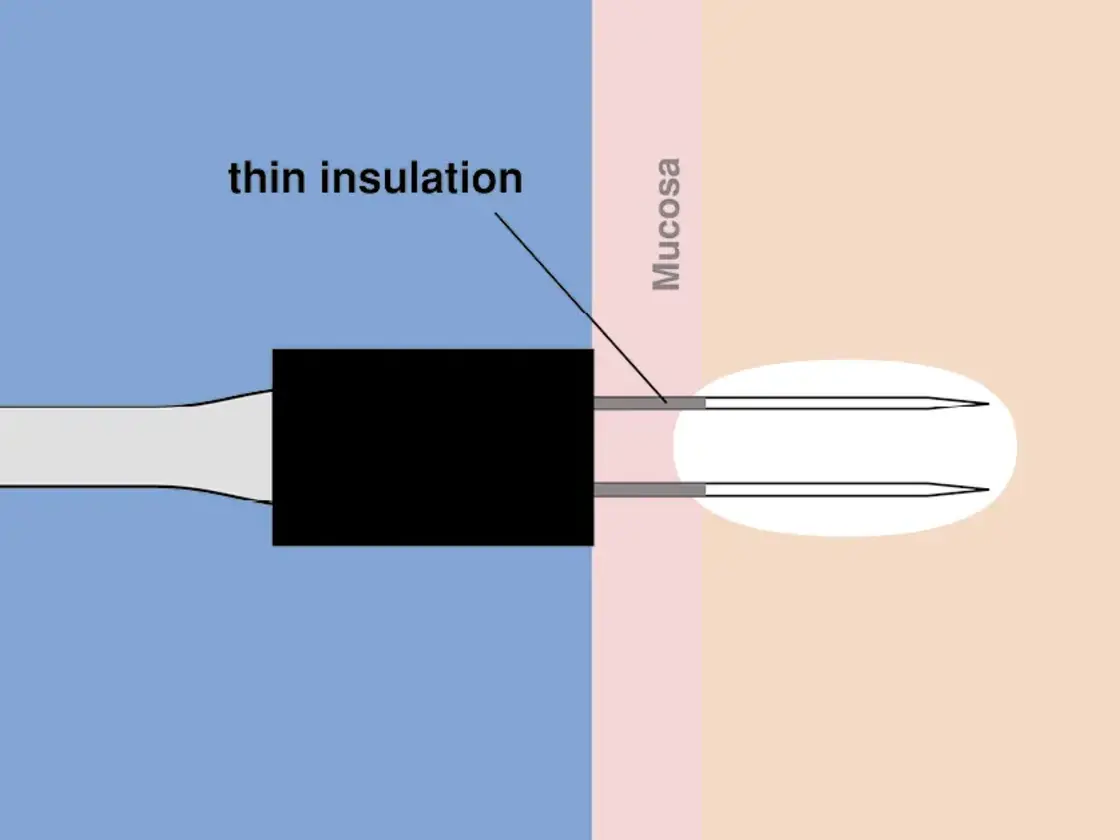 Grafische Darstellung einer korrekt platzierten RaVoR™ bipolare Elektrode. Das vollständige Einführen der dünnen Isolation schützt die Schleimhaut vor Oberflächenlasionen.
