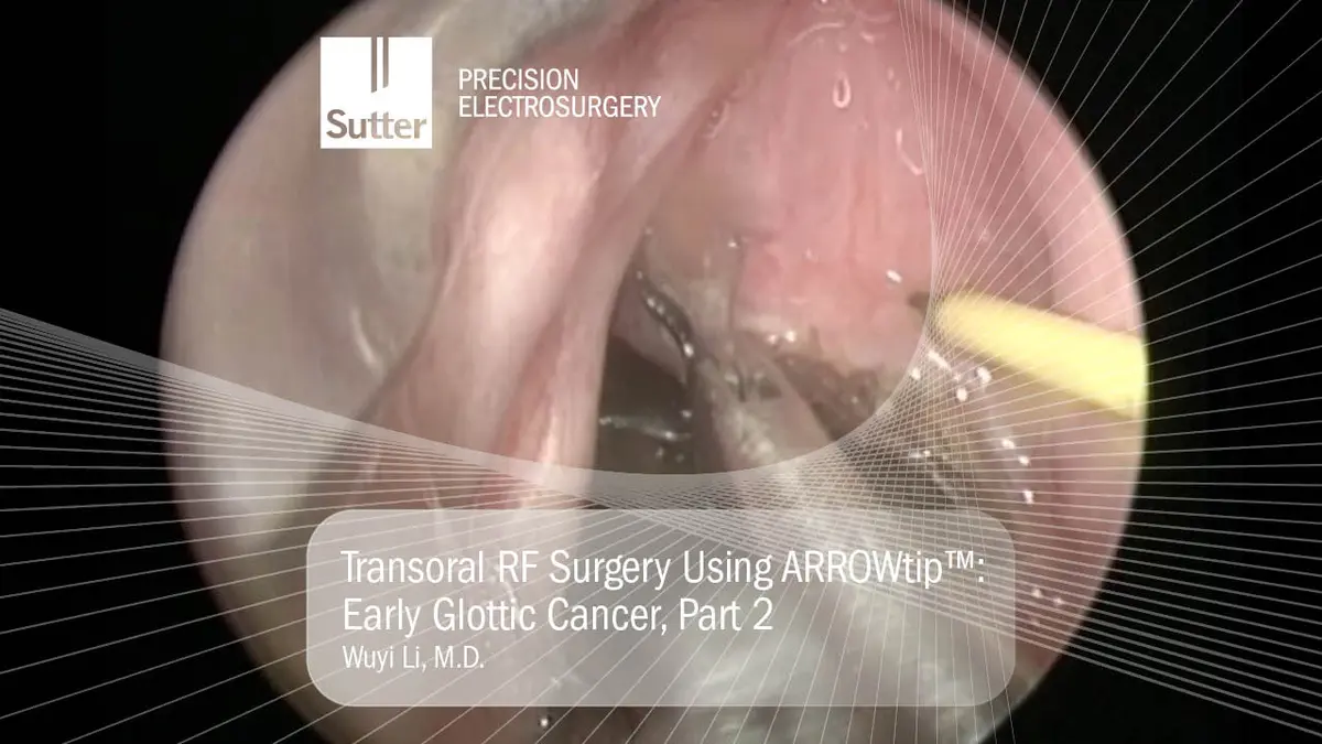 Endoskopisches Bild einer transoralen Radiofrequenz-Operation mit der ARROWtip™-Elektrode zur Behandlung eines frühen Glottiskarzinoms.