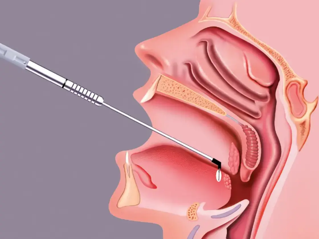 Grafische Darstellung des Einführens der RaVoR™ bipolaren Elektrode am Zungengrund