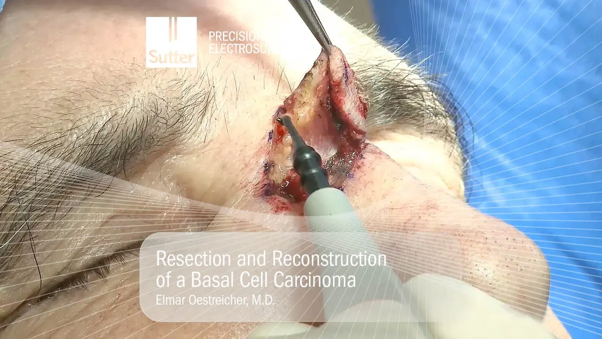 Resection and Reconstruction of a Basal Cell Carcinoma by Elmar Oestreicher, M.D.